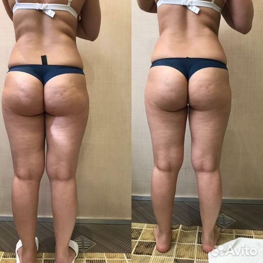 Антицеллюлитный массаж ручной