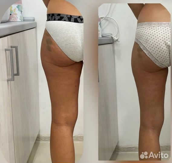 Аппаратный массаж