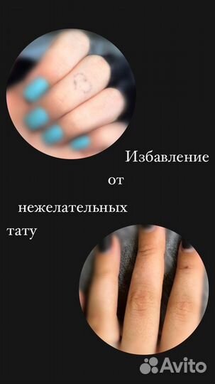 Лазерное удаление татуажа/тату. Карбоновый пилинг
