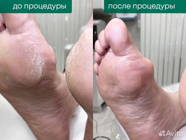 Подолог, лечение грибка, вросшие ногти, мозоли