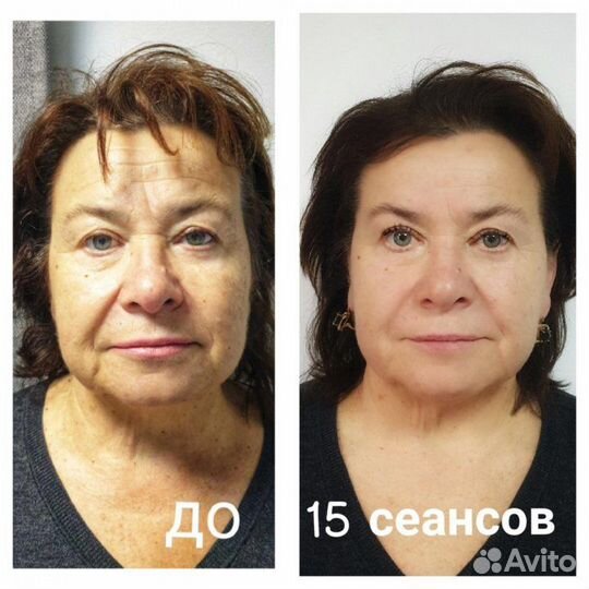 Скульптурно-буккальный массаж