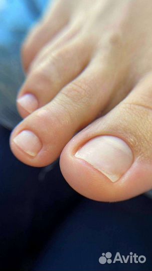 Педикюр / мозоли / вросшие ногти / трешины