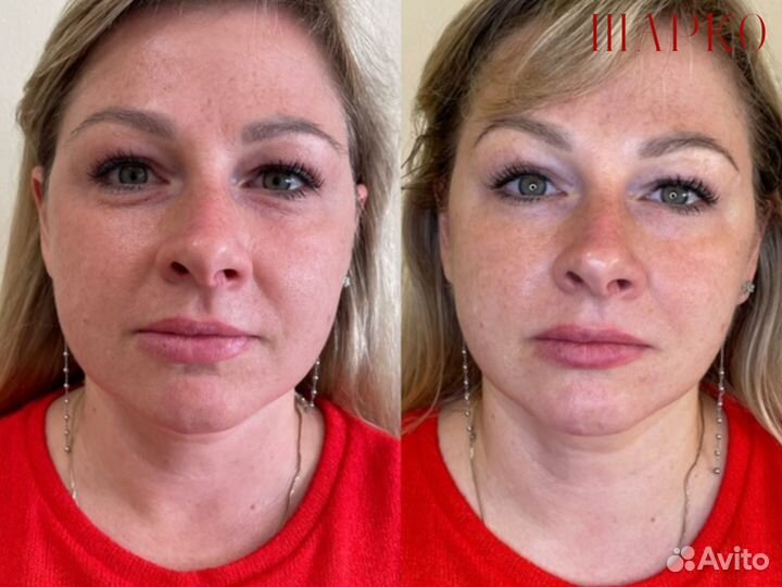 SMAS лифтинг / СМАС лифтинг