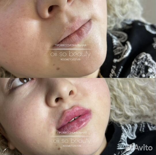 Увеличение губ, увлажнение 0,5мл, 1мл