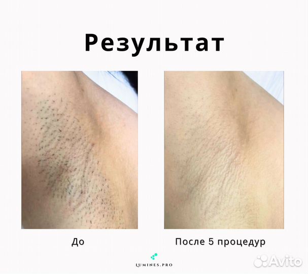 Аппарат для эпиляции Lumines’ Max One 1200в