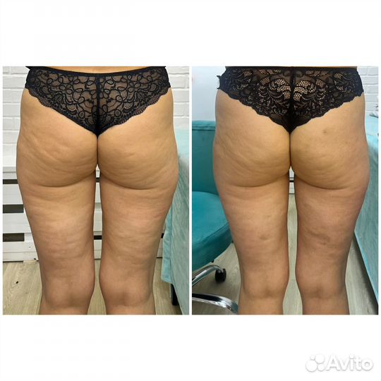 Аппаратный вакуумный массаж