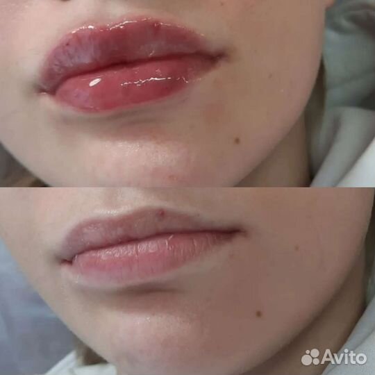 Увеличение губ