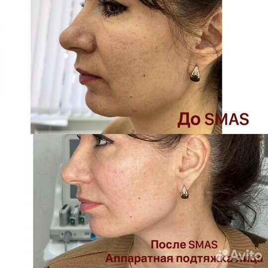 Аппаратная мезотерапия