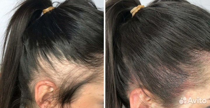 Трихопигментация женская загущение волос