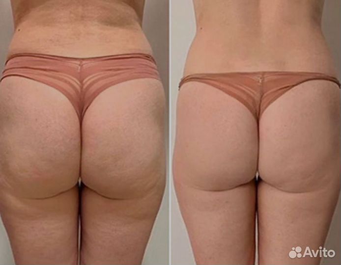 Аппаратный массаж сферами 60 мин антицеллюлит