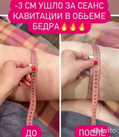 Мощный антицеллюлитный комплекс