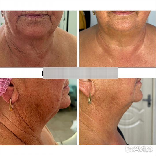 Аппаратный массаж лица