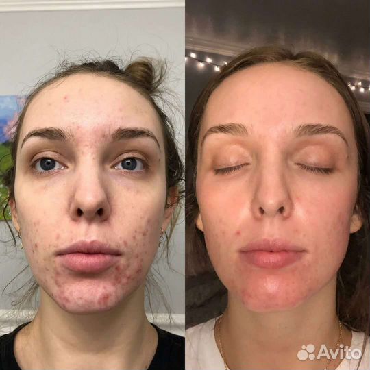 Лазерное лечение акне