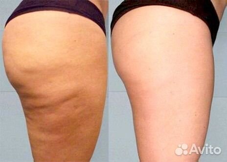 LPG массаж тела, массаж лица