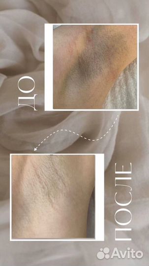 Лазерная эпиляция