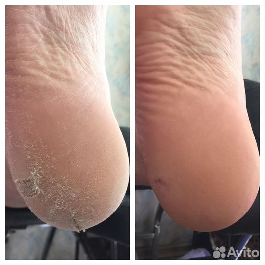 Подологический педикюр