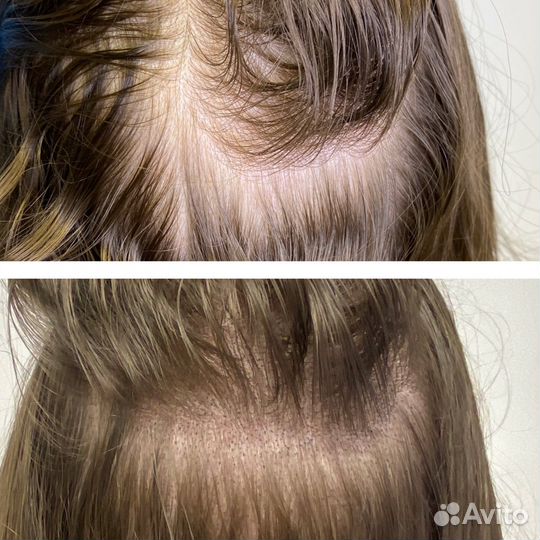 Трихопигментация головы