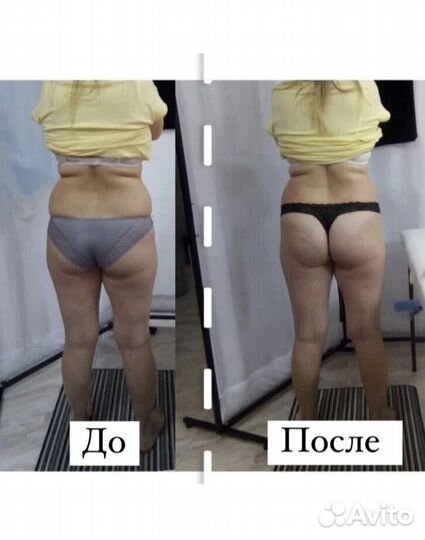 Аппаратная коррекция фигуры. Плoский живот
