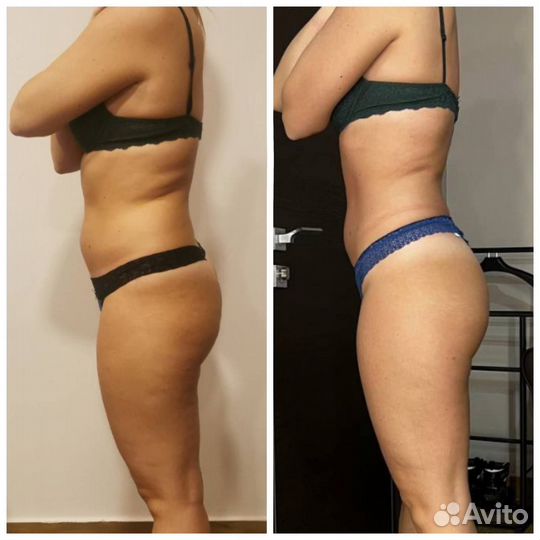 LPG массаж антицеллюлитный для похудения