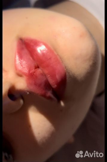 Контурная пластика