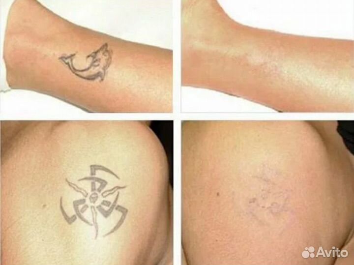 Как быстро свести тату. Как быстро свести тату. Этапы удаления татуировки лазером. Выведение татуировок лазером. Как быстро свести тату.