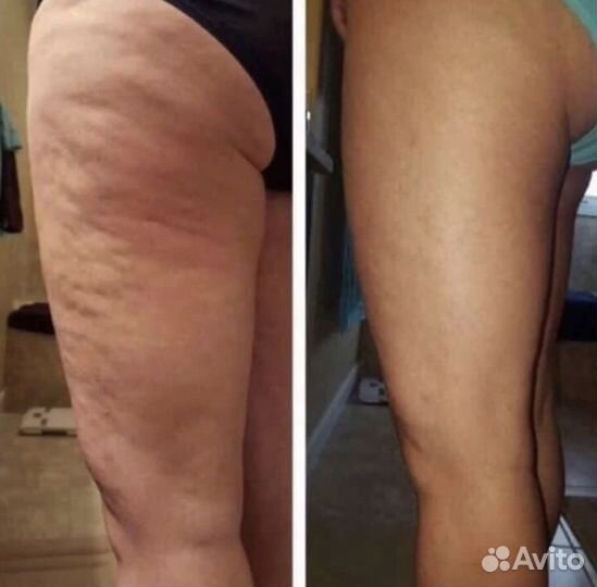 Антицеллюлитный крем