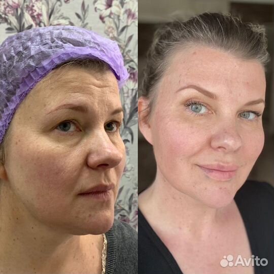 Косметолг Ботокс /бьютификация /липолитики