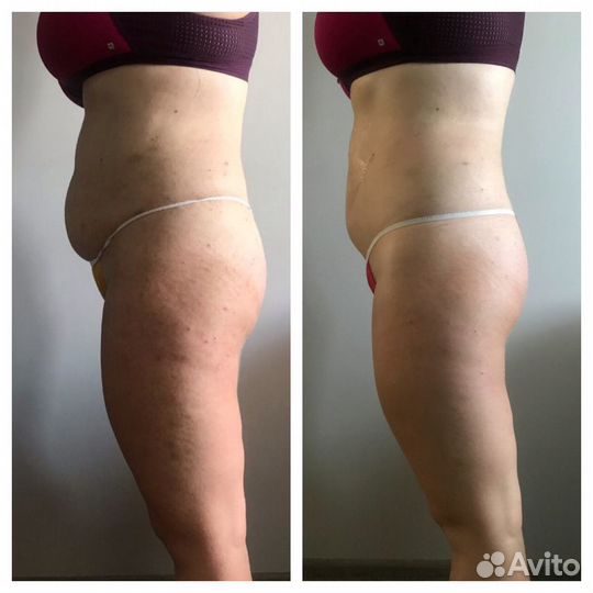 Антицеллюлитный массаж