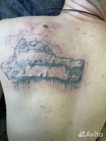 Удаление татуажа перманентного макияжа бровей губ