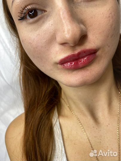 Увеличение губ