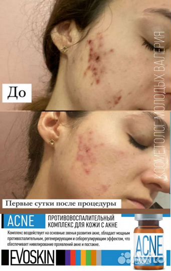 Контурная пластика