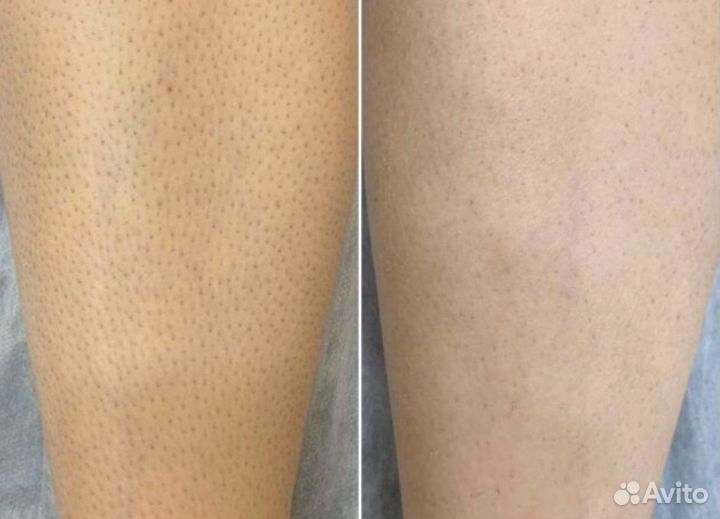 Лазерная эпиляция диодный лазер