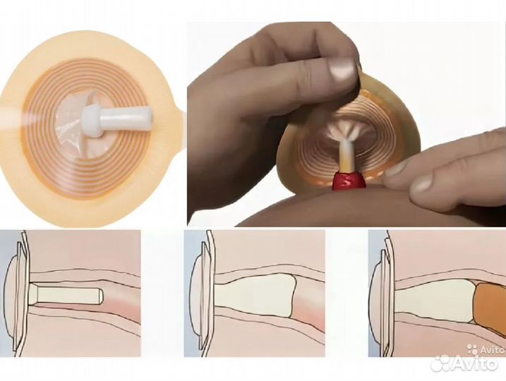 Тампон для стомы, стома-крышка, полукольца, пояса