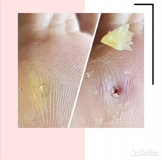 Медицинский педикюр