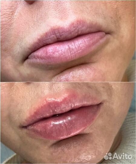 Контурная пластика губ