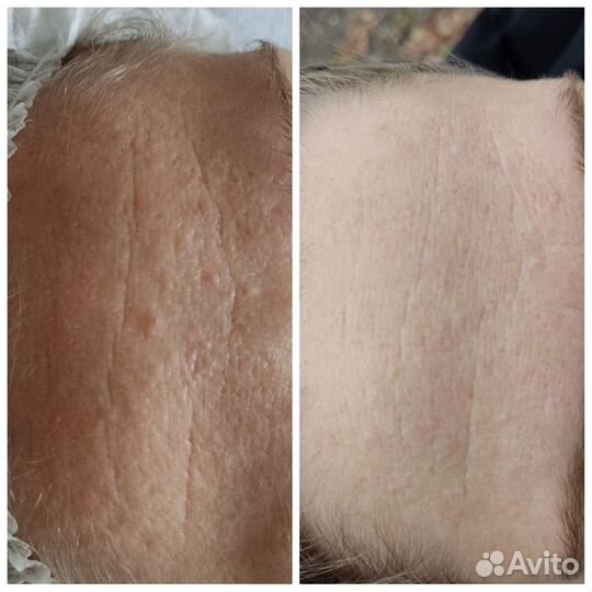 Массаж лица