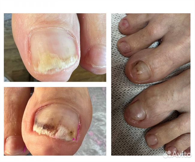 Подолог педикюр любой сложности, вросший ноготь