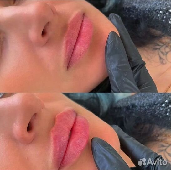 Увеличение губ. Без боли