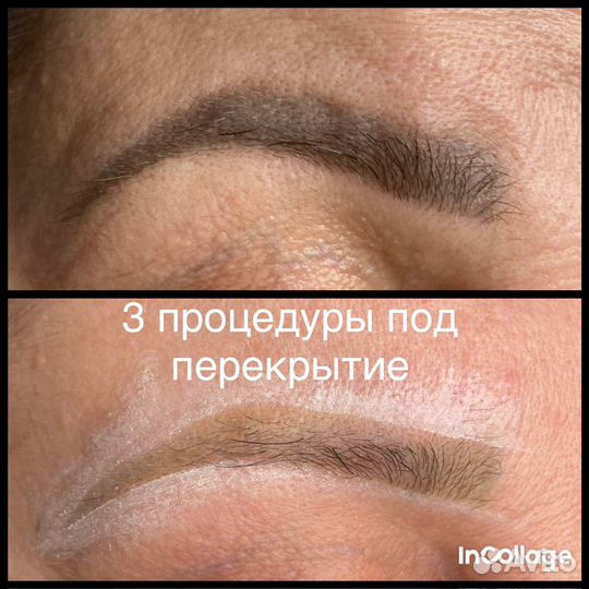 Удаление тату, татуажа, карбоновый пилинг