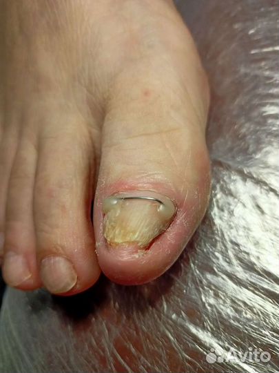 Лечебный педикюр