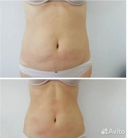 Плоский живот - размер за 1 процедуру в Красноярск