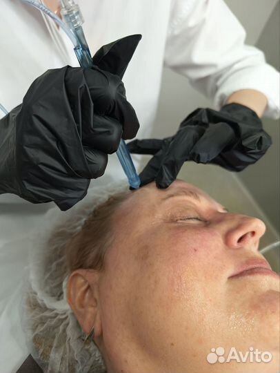 Выпадение волос, алопеция,жирность кожи головы