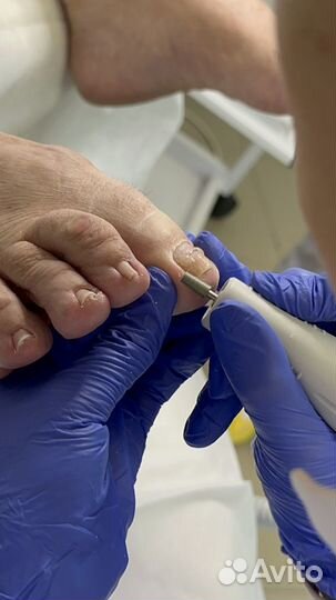 Лечебный маникюр,педикюр,грибок,трещины,грибок