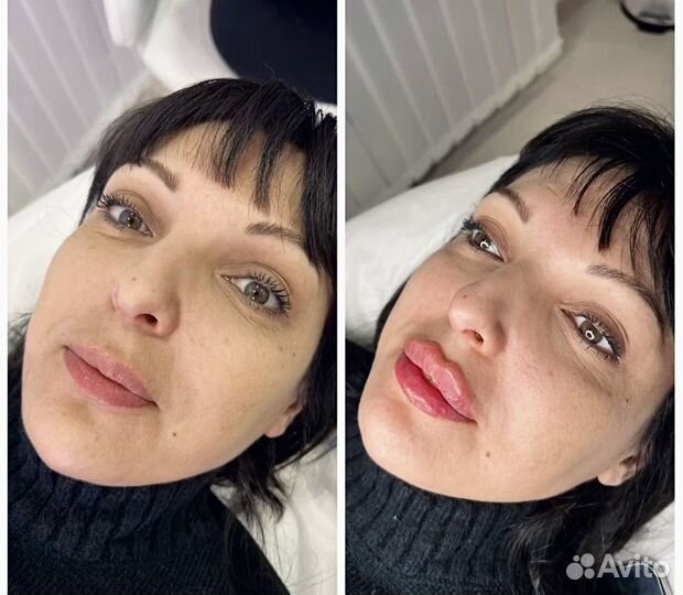 Контурная пластика лица