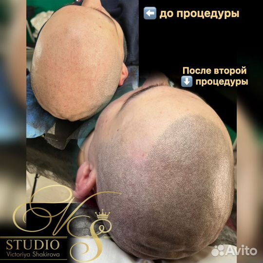 Трихопигментация SMP головы