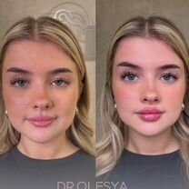 Увеличение губ, углы Джоли, Full Face, Diolaze XL