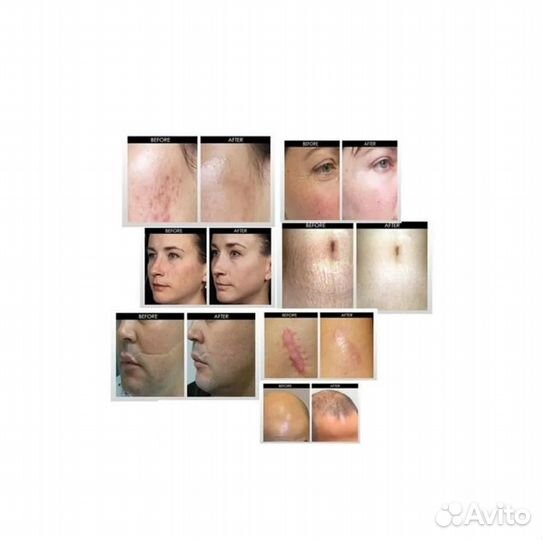 Мезороллер для кожи, с колбой для сыворотки, 64 иг