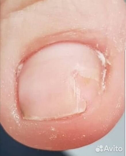 Медицинский педикюр