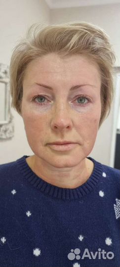 Смас лифтинг