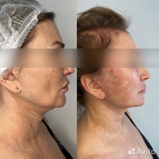 Нити Metod, Aptos, Аптос, Ког, Молдинги